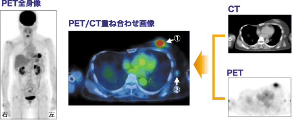 左乳癌、リンパ節転移